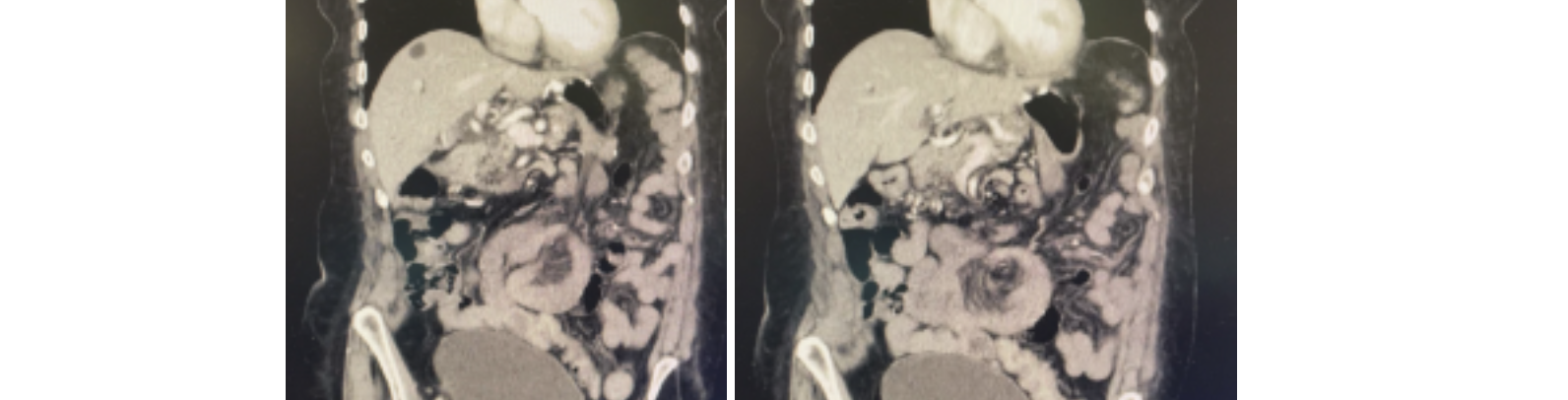 Internal Hernia – Mini Case Report